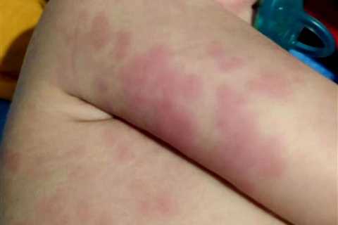 Parents warned to watch out for nasty rash that can strike toddlers with Covid