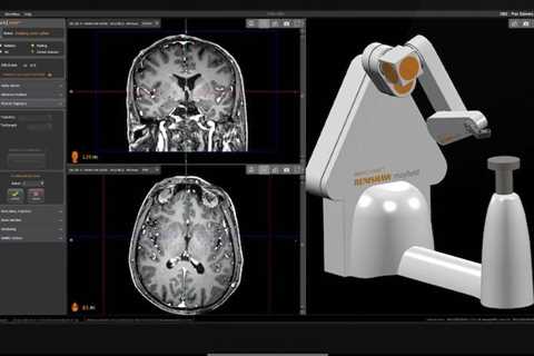 Renishaw’s neuromate robot receives EU MDR certification