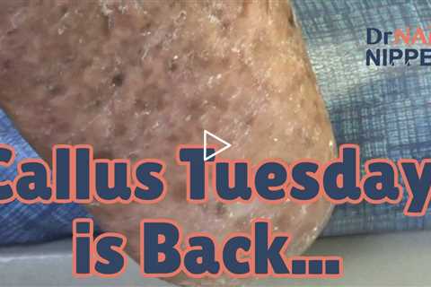 Callus Tuesday is Back (2022)