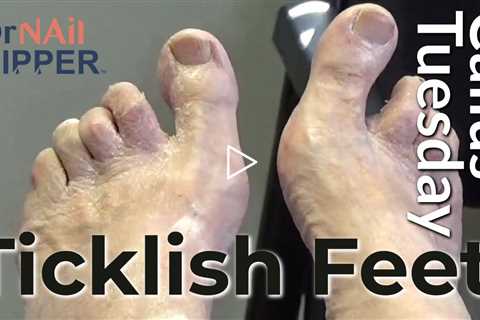 Are feet ticklish?  Patient has sensitive toes and toenails for Dr Nail Nipper (2022)