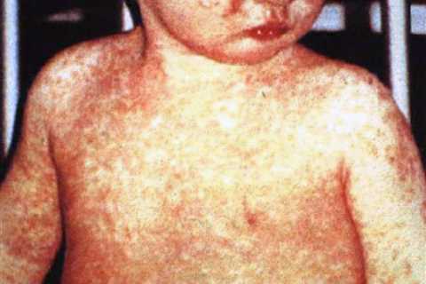 Measles outbreak temporarily closes childcare facility in Columbus