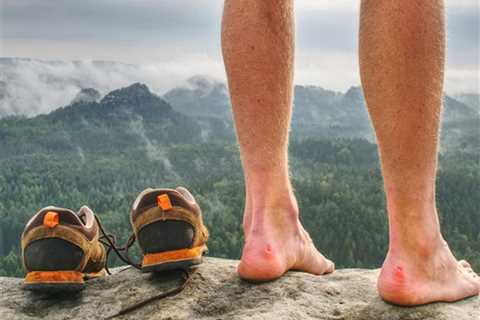 Should You Pop a Blister When Hiking?