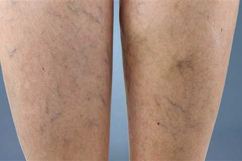 Treating Vein Diseases in St. Louis, Missouri: Exercises and Therapies to Consider