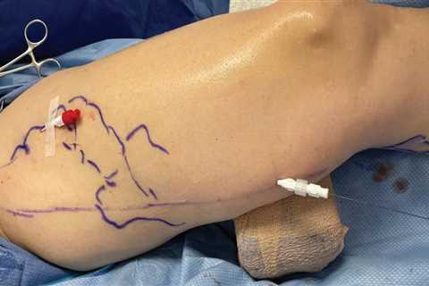 High Success Rate of Ambulatory Phlebectomy for Treating Vein Diseases in St. Louis, Missouri