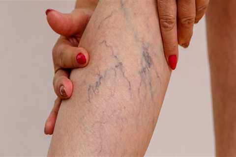 Treating Venous Insufficiency in St. Louis, Missouri: Dietary Changes to Consider