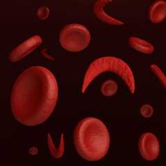 Risk for bacteremia low among children with sickle cell disease, fever