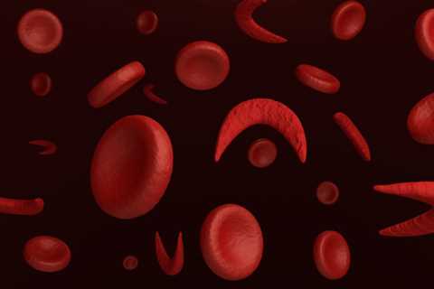 Risk for bacteremia low among children with sickle cell disease, fever