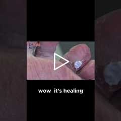 Healing an Open Wound Under a Callus #callus #openwound #healing