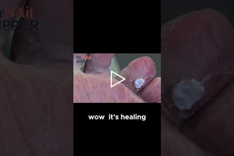 Healing an Open Wound Under a Callus #callus #openwound #healing