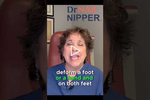 Severe Rheumatoid Arthritis on the Feet - Intro