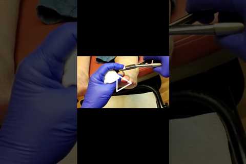 Dealing with Gout A Finger Issue  #GoutAwareness #HealthTips #UnexpectedSymptoms