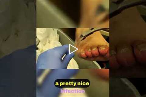 Unique Nail Treatment Insights 🦶💡