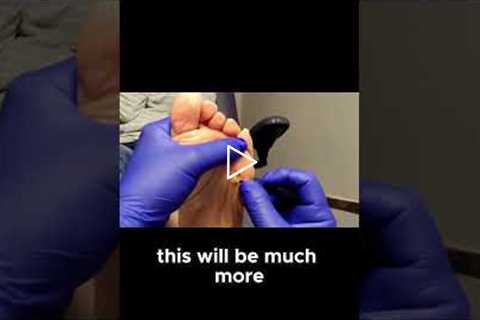 Why You Should Never Ignore a Keratotic Horn on Your Foot!