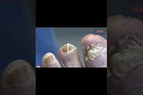 Why Do Heel Pads Go Flat? The Surprising Truth About Aging Feet! 👣