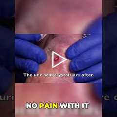 Gout Case Surprising Lack of Pain