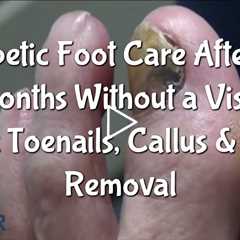 Classic - Diabetic Foot Care After 18 Months Without a Visit | Thick Toenails, Callus & Corn Removal
