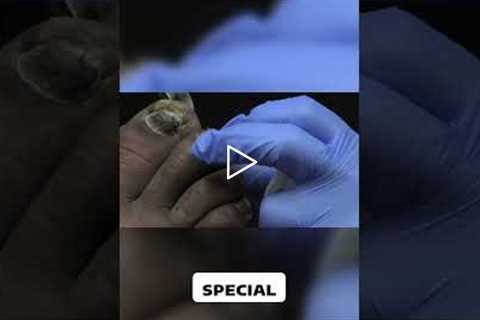 Choosing the Right Footwear for Diabetes Management