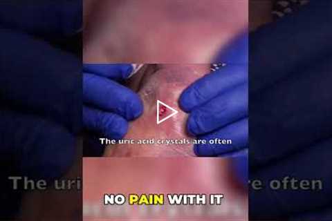 Gout Case Surprising Lack of Pain