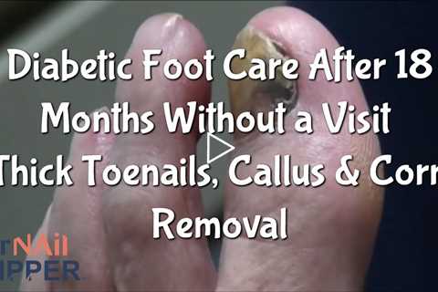 Classic - Diabetic Foot Care After 18 Months Without a Visit | Thick Toenails, Callus & Corn Removal