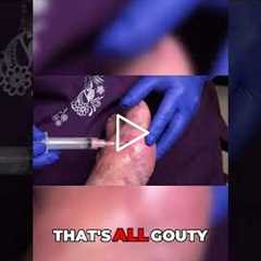 Urgent Treatment Fluid Drainage Process Explained #DrNailNipper #GoutTreatment #FluidDrainage