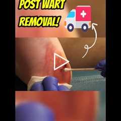 Aftercare Tips Post Wart Removal! 🚑