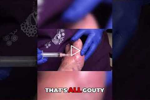 Urgent Treatment Fluid Drainage Process Explained #DrNailNipper #GoutTreatment #FluidDrainage