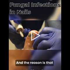 Why Nail Fungus Starts at the Root (And Why Creams Don’t Work)