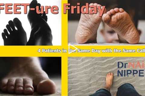 FEET-ure Friday | 4 Patients in the Same Day with the Same Callus!! 👣🔥