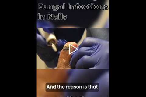 Why Nail Fungus Starts at the Root (And Why Creams Don’t Work)