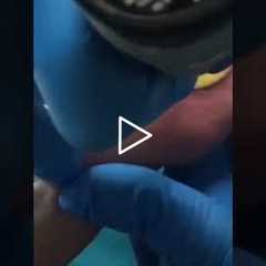 From Painful Shoes to Total Comfort — A Patient’s Story | Original Rams Horn Toenail – Final