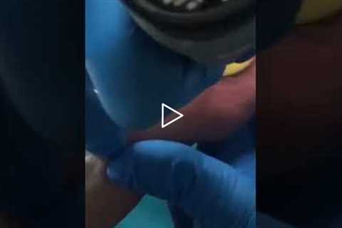 From Painful Shoes to Total Comfort — A Patient’s Story | Original Rams Horn Toenail – Final