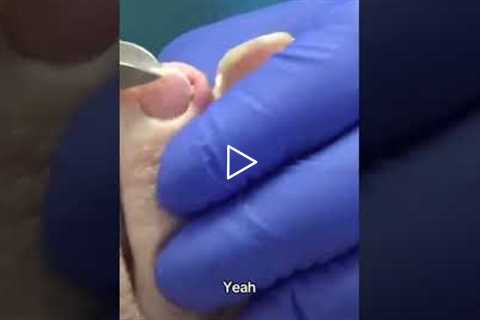 The Hidden Downsides of Compression Socks 👀