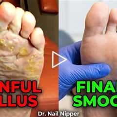 Painful Genetic Callus Removed – Instant Relief!