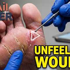 She Didn’t Feel This Wound… (Diabetic Foot Care Warning)