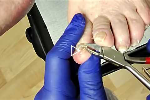 FEET-ure Friday Short video - Two Patients and One Jump Scare