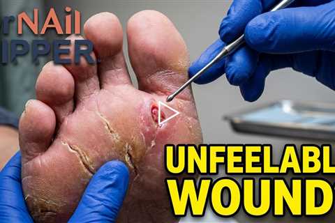 She Didn’t Feel This Wound… (Diabetic Foot Care Warning)