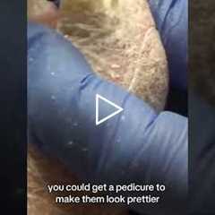 Can a pedicure make these nails look prettier Insurance says no, but maybe there's another way