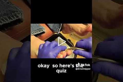Daily Foot Checks A Diabetic's Routine