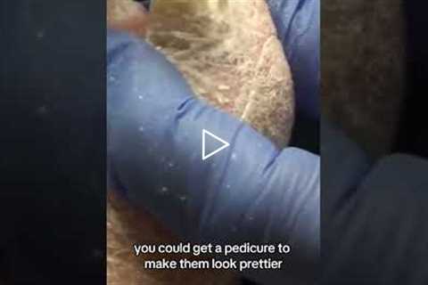 Can a pedicure make these nails look prettier Insurance says no, but maybe there's another way