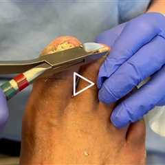 Ganglion Cyst Drainage and Foot Care Explained -- Highlight