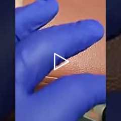 😲 We're Relaxing... No, We're Draining a Cyst! | Instant Relief