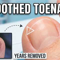 Removing Years of Nail Polish & Smoothing Sensitive Toenails | Podiatry Care
