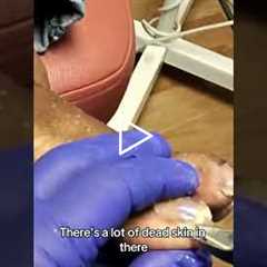 Podiatrist Finds 'Dead Skin' in Patient's Foot