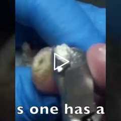 The Most Satisfying Part of a Foot Procedure
