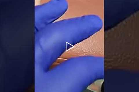 😲 We're Relaxing... No, We're Draining a Cyst! | Instant Relief