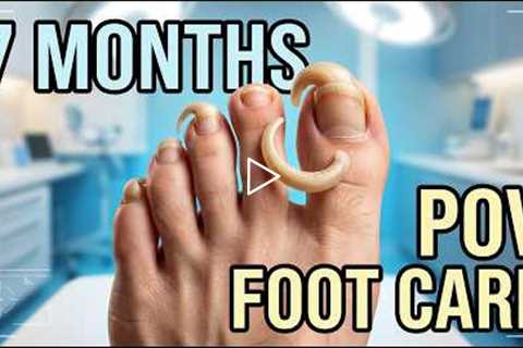 FEET-ure Friday |  Her Toenails Curled UNDER Her Toes After 7 Months 😳🦶