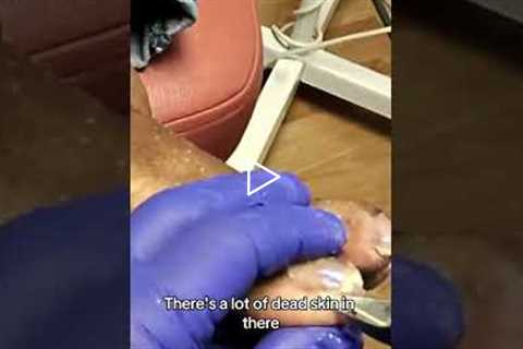 Podiatrist Finds 'Dead Skin' in Patient's Foot