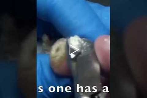 The Most Satisfying Part of a Foot Procedure