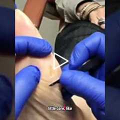 How to remove calluses and corns