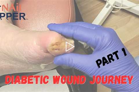 FEET-ure Friday |  She Thought It Was Just Cracked Skin... It Was a Diabetic Foot Wound 😳🦶 - Part ..